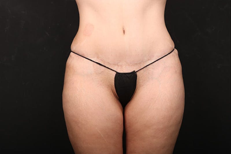 Abdominoplasty Before & After Gallery - Patient 259408 - Image 2