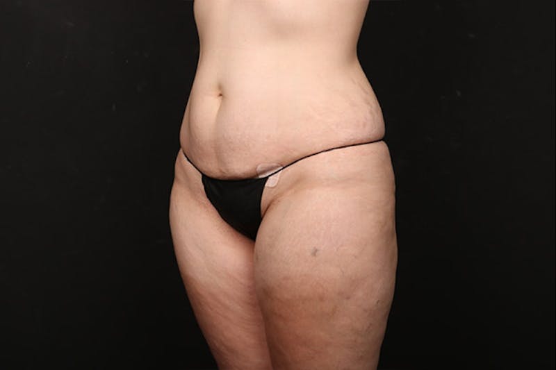 Abdominoplasty Before & After Gallery - Patient 259408 - Image 3