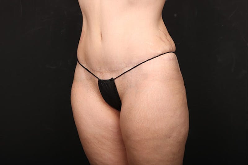 Abdominoplasty Before & After Gallery - Patient 259408 - Image 4