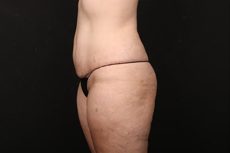 Abdominoplasty Before & After Gallery - Patient 259408 - Image 5