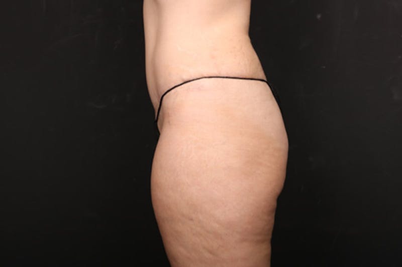 Abdominoplasty Before & After Gallery - Patient 259408 - Image 6