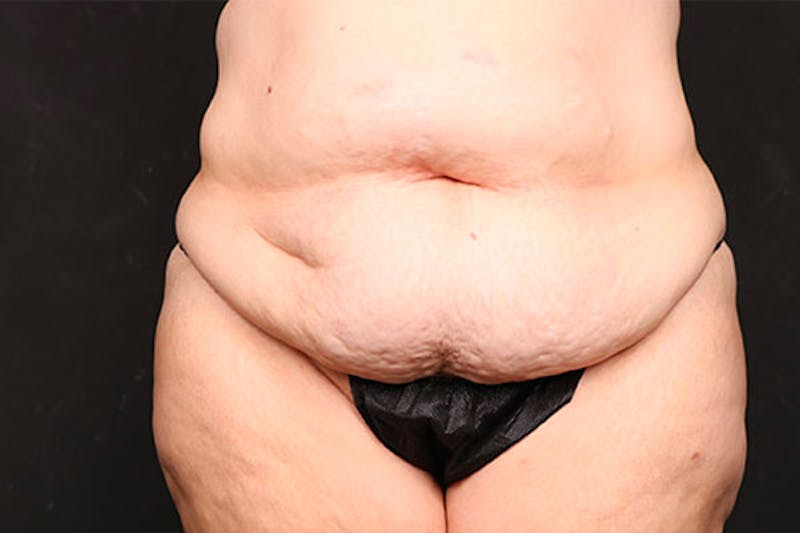Abdominoplasty Before & After Gallery - Patient 218631 - Image 1