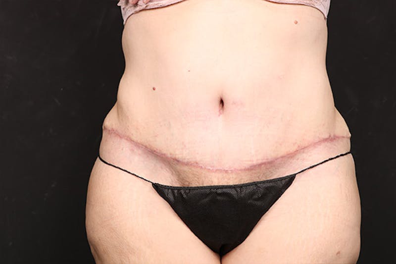 Abdominoplasty Before & After Gallery - Patient 218631 - Image 2
