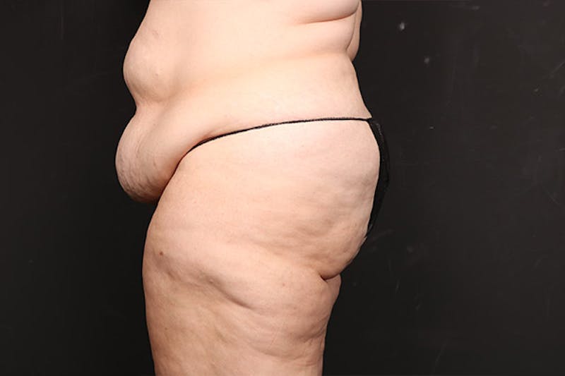 Abdominoplasty Before & After Gallery - Patient 218631 - Image 3