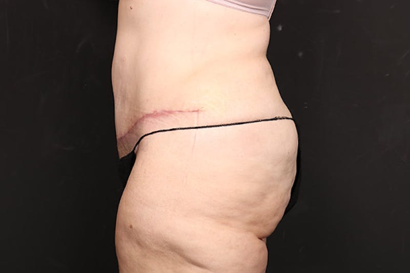 Abdominoplasty Before & After Gallery - Patient 218631 - Image 4