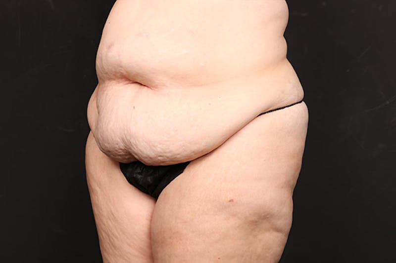Abdominoplasty Before & After Gallery - Patient 218631 - Image 5