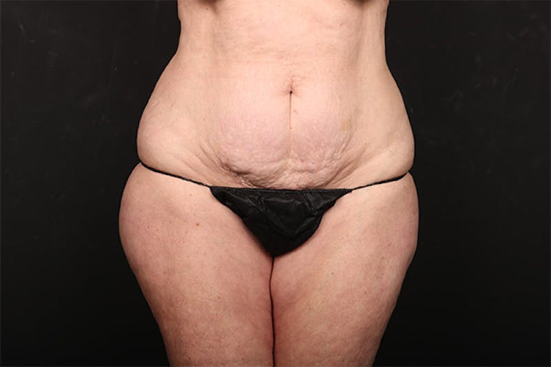 Abdominoplasty Before & After Gallery - Patient 118304 - Image 1