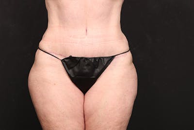 Abdominoplasty Before & After Gallery - Patient 118304 - Image 2