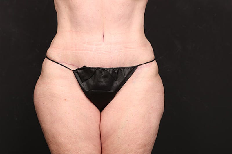 Abdominoplasty Before & After Gallery - Patient 118304 - Image 2