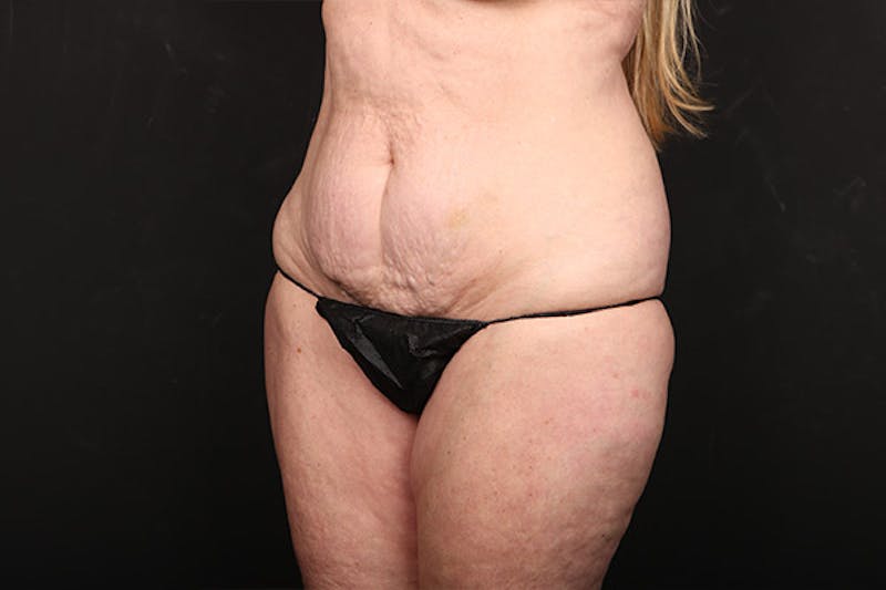 Abdominoplasty Before & After Gallery - Patient 118304 - Image 3