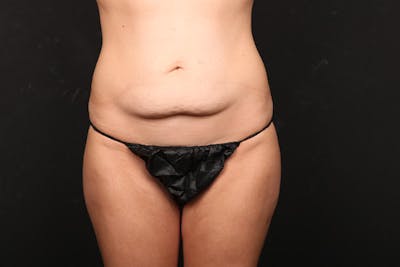 Abdominoplasty Before & After Gallery - Patient 358785 - Image 1