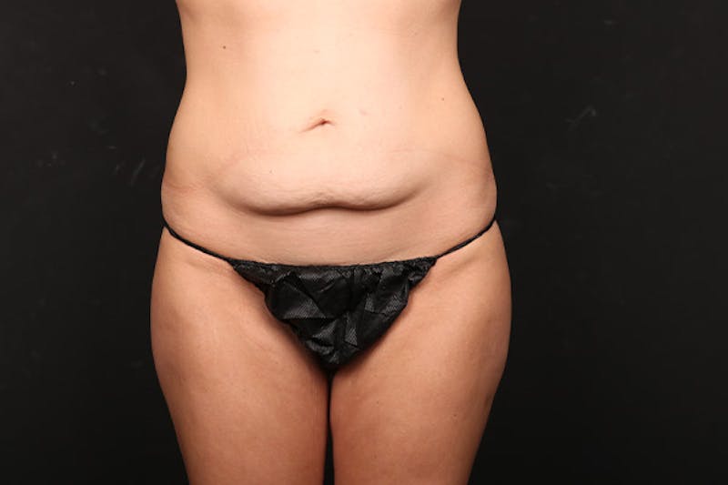 Abdominoplasty Before & After Gallery - Patient 358785 - Image 1