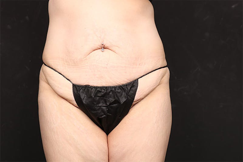 Abdominoplasty Before & After Gallery - Patient 282343 - Image 1