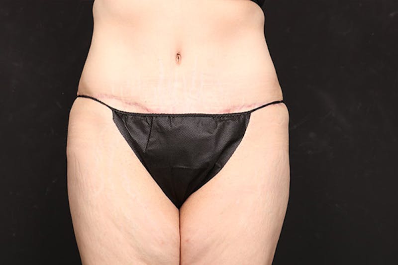 Abdominoplasty Before & After Gallery - Patient 282343 - Image 2