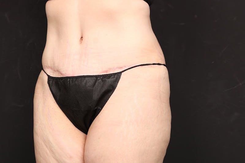 Abdominoplasty Before & After Gallery - Patient 282343 - Image 4