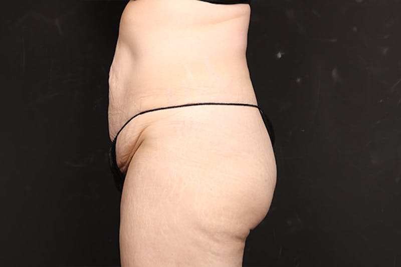 Abdominoplasty Before & After Gallery - Patient 282343 - Image 5