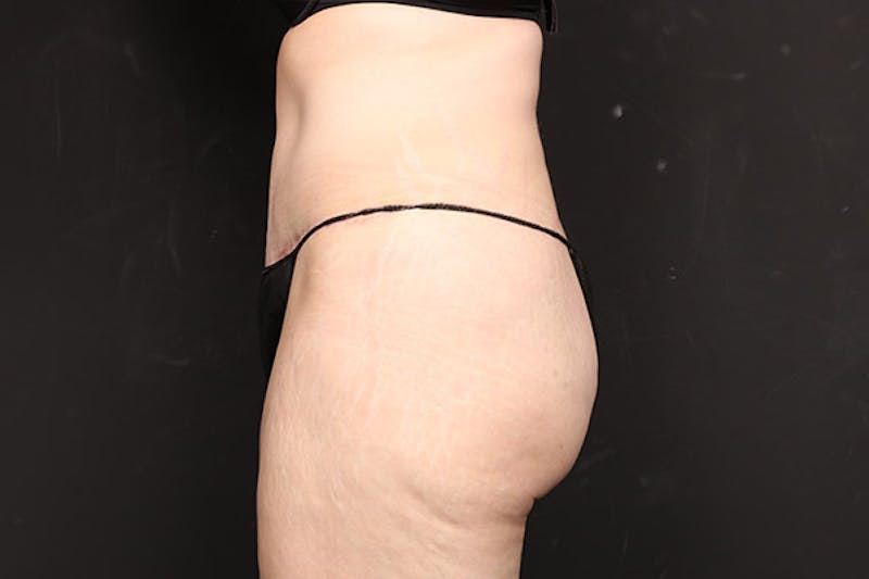 Abdominoplasty Before & After Gallery - Patient 282343 - Image 6