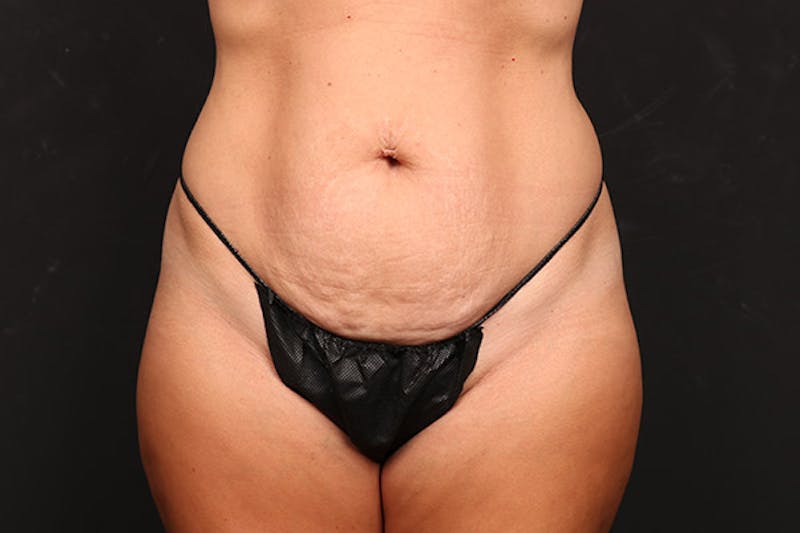 Abdominoplasty Before & After Gallery - Patient 224367 - Image 1