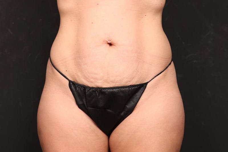 Abdominoplasty Before & After Gallery - Patient 224367 - Image 2