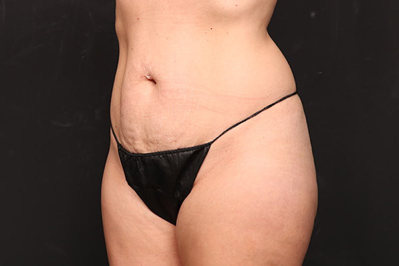 Abdominoplasty Before & After Gallery - Patient 224367 - Image 4