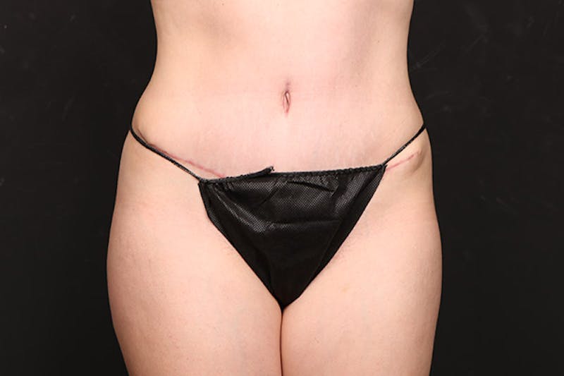 Abdominoplasty Before & After Gallery - Patient 264892 - Image 2