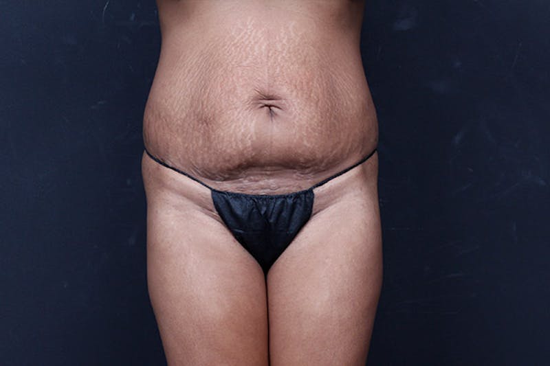 Mommy Makeover Before & After Gallery - Patient 346244 - Image 7