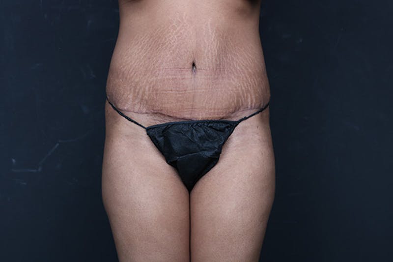Mommy Makeover Before & After Gallery - Patient 346244 - Image 8