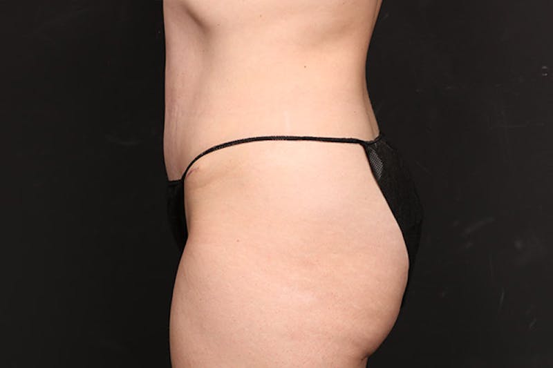 Abdominoplasty Before & After Gallery - Patient 264892 - Image 6