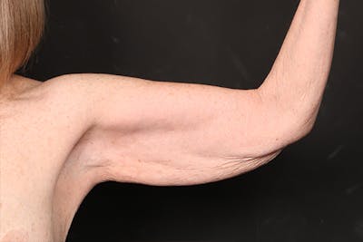 Arm Lift Before & After Gallery - Patient 102879 - Image 1