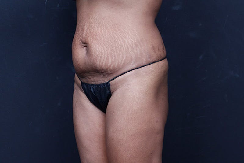Mommy Makeover Before & After Gallery - Patient 346244 - Image 9