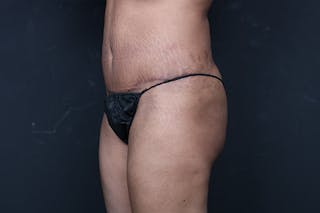 Mommy Makeover Before & After Gallery - Patient 346244 - Image 10