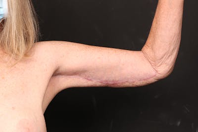 Arm Lift Before & After Gallery - Patient 102879 - Image 2