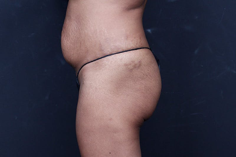 Mommy Makeover Before & After Gallery - Patient 346244 - Image 11