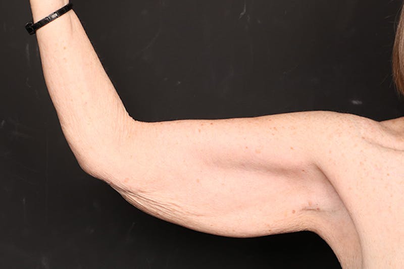 Arm Lift Before & After Gallery - Patient 102879 - Image 3