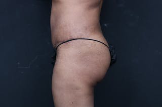 Mommy Makeover Before & After Gallery - Patient 346244 - Image 12