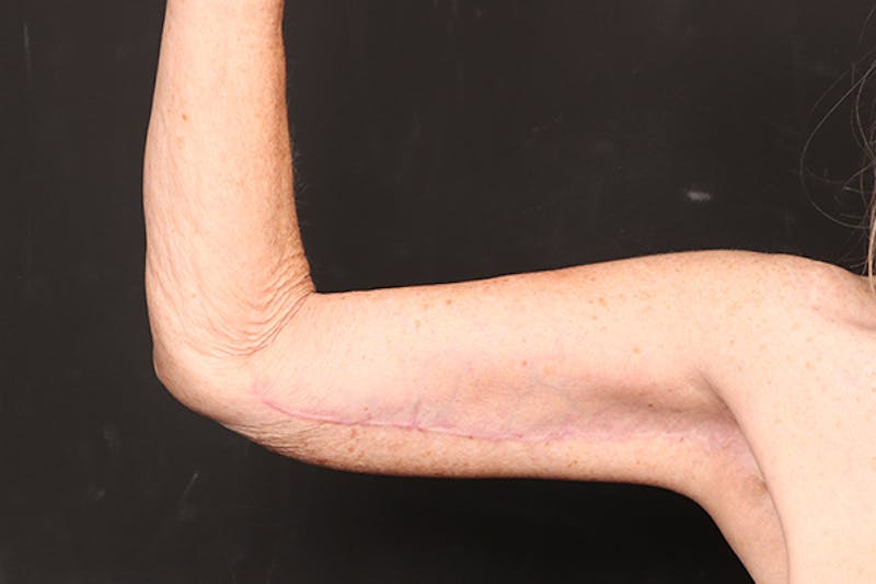 Arm Lift Before & After Gallery - Patient 102879 - Image 4