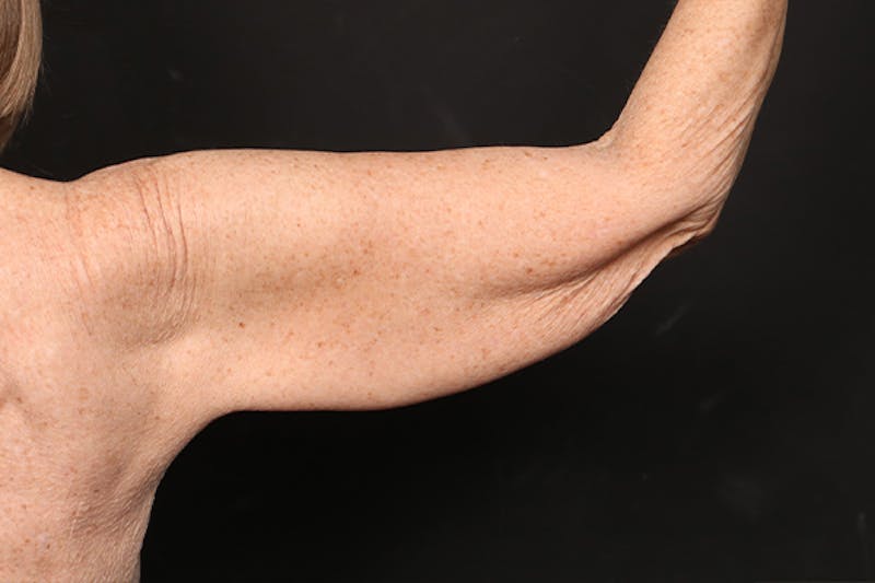 Arm Lift Before & After Gallery - Patient 102879 - Image 5