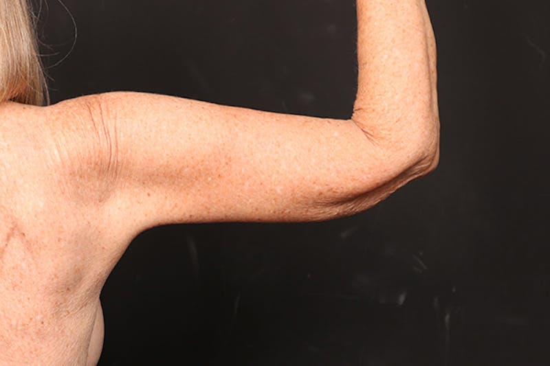 Arm Lift Before & After Gallery - Patient 102879 - Image 6