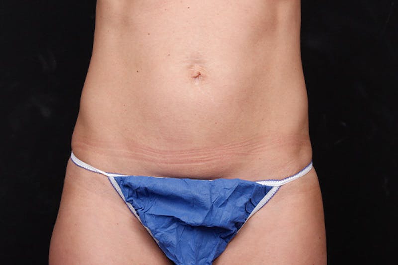 Abdominoplasty Before & After Gallery - Patient 224746 - Image 1