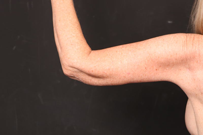 Arm Lift Before & After Gallery - Patient 102879 - Image 8