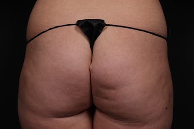 Brazilian Butt Lift Before & After Gallery - Patient 145423 - Image 1