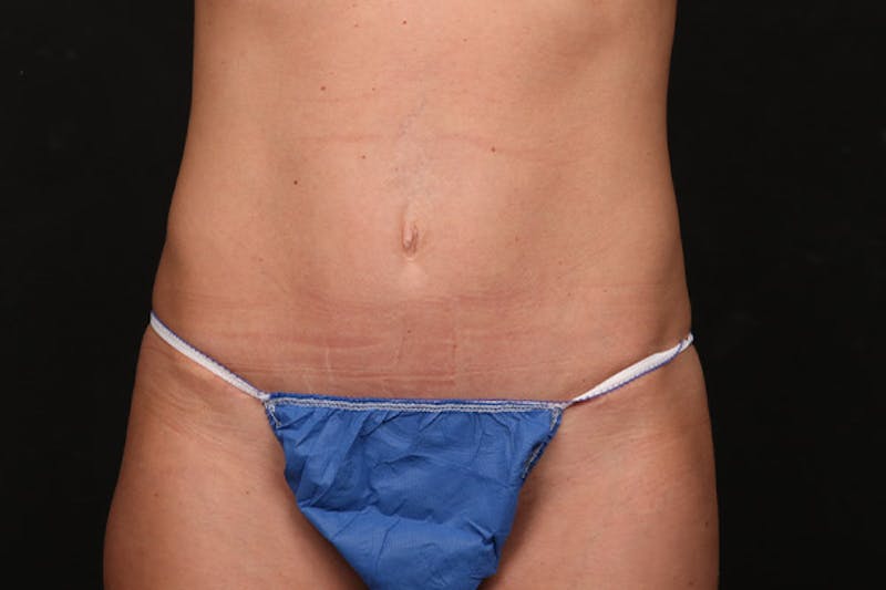 Abdominoplasty Before & After Gallery - Patient 224746 - Image 2