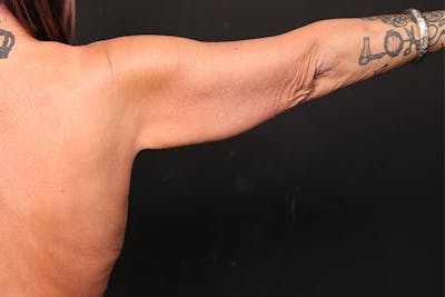 Arm Lift Before & After Gallery - Patient 239003 - Image 1