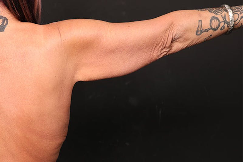 Arm Lift Before & After Gallery - Patient 239003 - Image 1