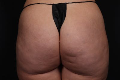 Brazilian Butt Lift Before & After Gallery - Patient 145423 - Image 2
