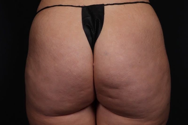 Brazilian Butt Lift Before & After Gallery - Patient 145423 - Image 2