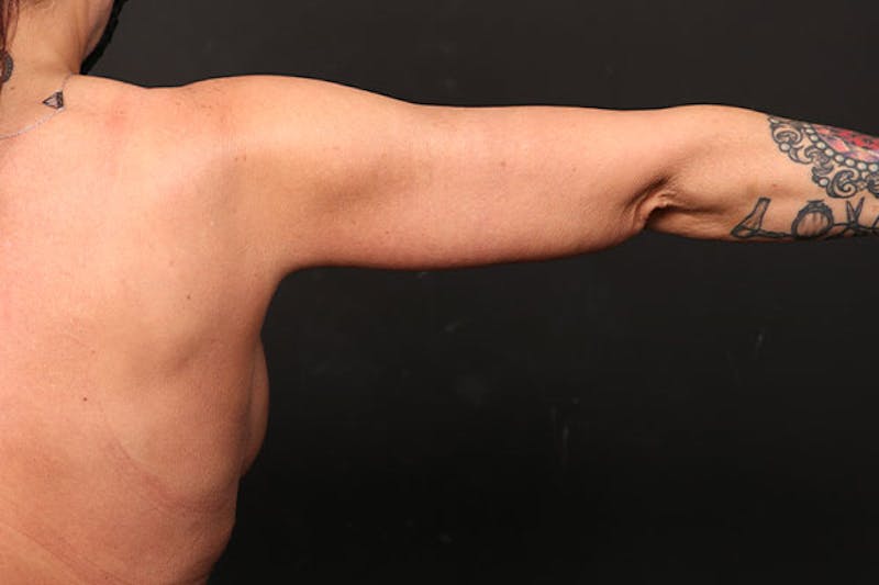 Arm Lift Before & After Gallery - Patient 239003 - Image 2