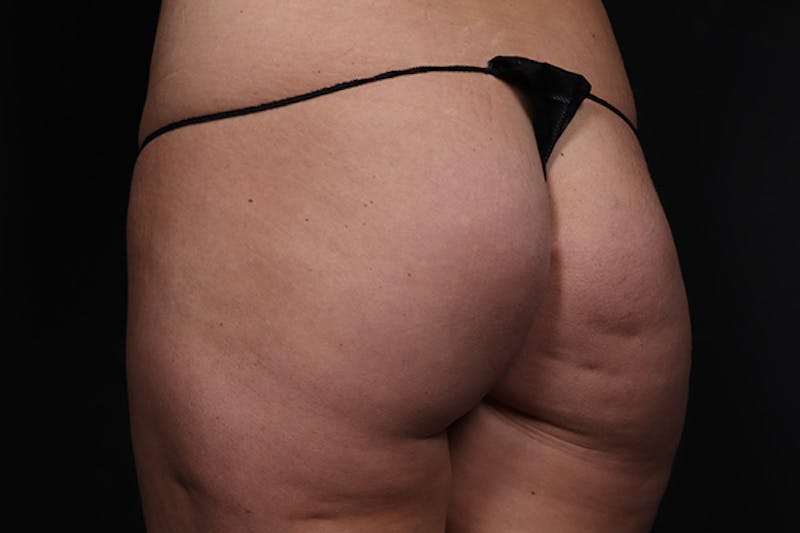 Brazilian Butt Lift Before & After Gallery - Patient 145423 - Image 3