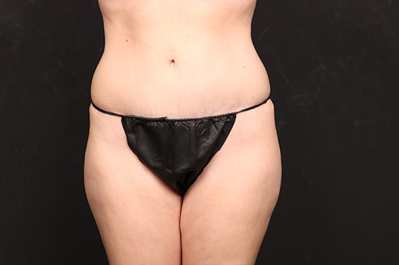Mommy Makeover Before & After Gallery - Patient 404053 - Image 8