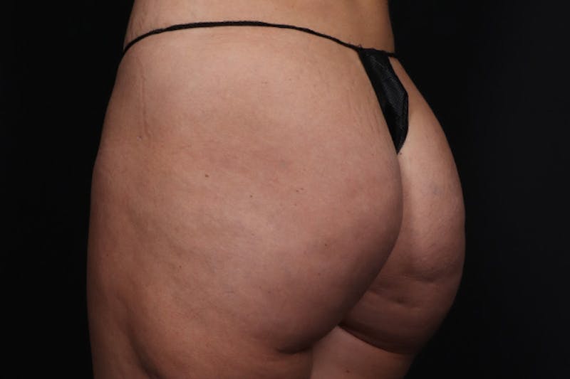 Brazilian Butt Lift Before & After Gallery - Patient 145423 - Image 4